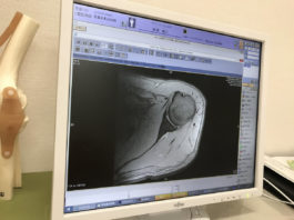 福井総合クリニックの山門先生に診ていただいた左肩のレントゲン